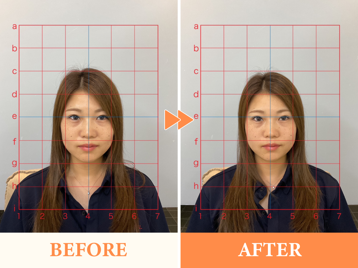 小顔矯正×リフトアップ美容鍼のビフォーアフター