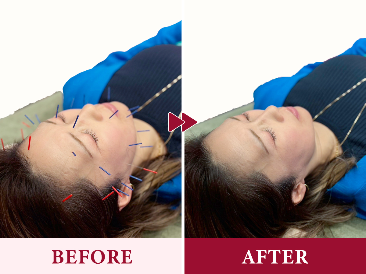 美容鍼のビフォーアフター