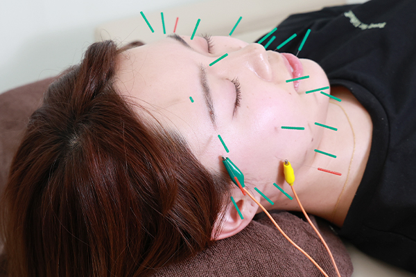 数少ない本数での美容鍼施術