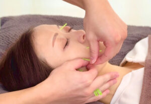 当院の美容鍼小顔矯正